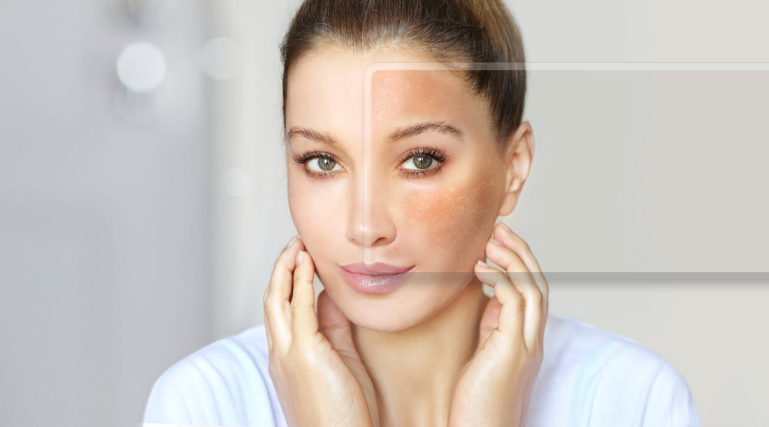 Woman touching her face, showing clear skin on one side and hyperpigmentation on the other.