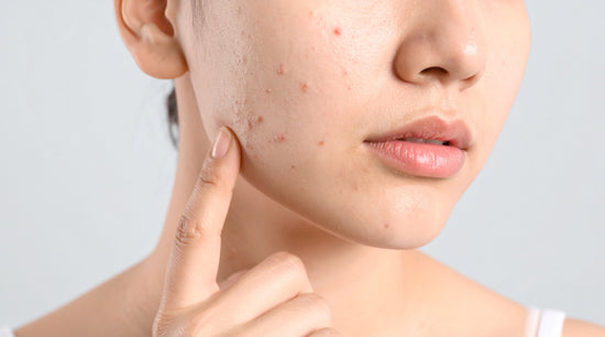 Close-up of acne-prone skin with small pimples, illustrating a step-by-step skincare routine for acne-prone skin.