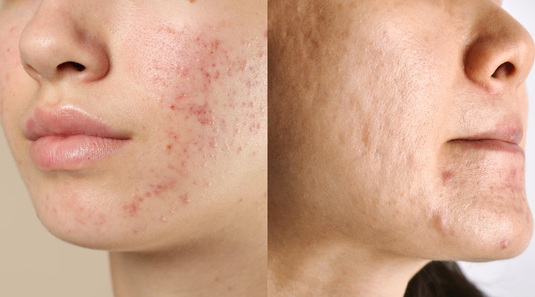 Split image showing a face with active acne and red marks on one side, and smoother skin with healed acne scars on the other side.