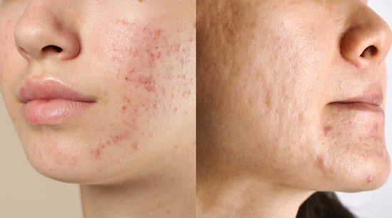 Split image showing a face with active acne and red marks on one side, and smoother skin with healed acne scars on the other side.