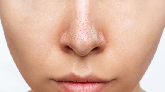 Close-up of a face showing visible blackheads and enlarged pores on the nose.