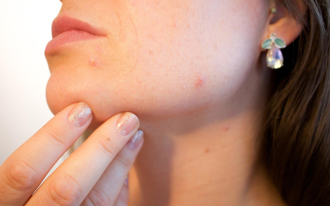 Close-up of a woman's jawline with acne and blemishes, highlighting common skin problems during summer